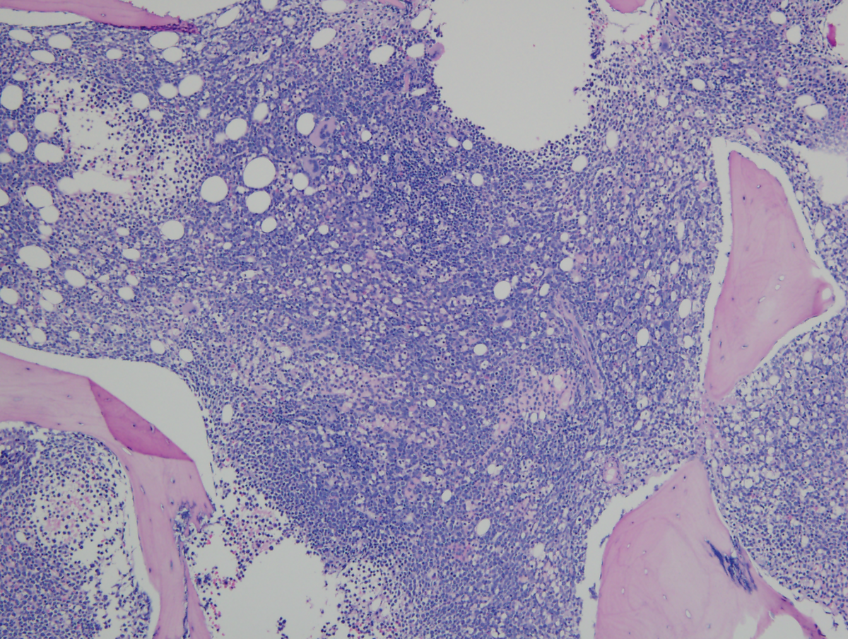 Figure 3: Bone marrow core biopsy showing hypercellular marrow (100x magnification).